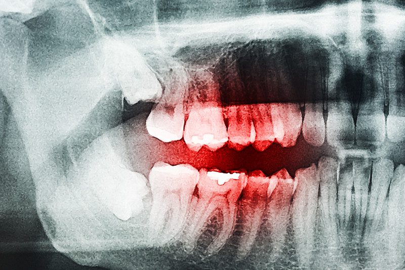 tooth xray